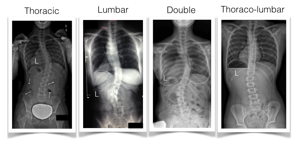 Scoliosis Curve Patterns - 4 Most Common Types